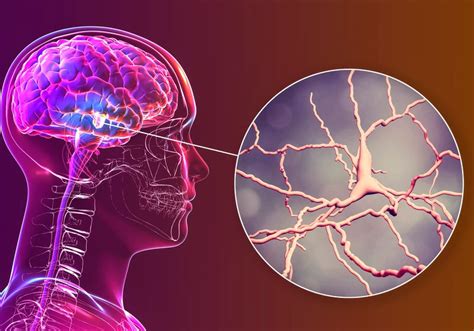 Specific Brain Cells Linked to Parkinson's Disease | The Scientist Magazine®