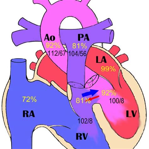 Right to left cardiac shunt symptoms