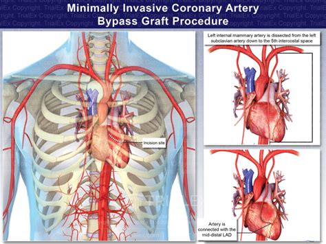 Coronary Artery Bypass Graft