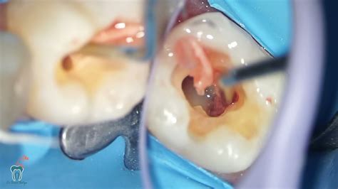 inside a tooth ischemic nerve - YouTube