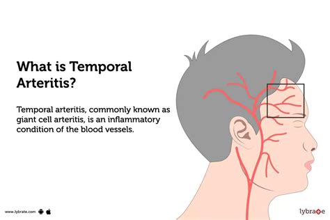 Temporal Arteritis: Causes, Symptoms, Treatment and Cost