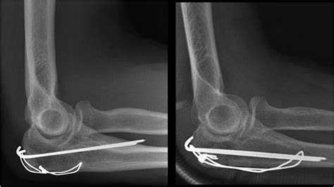 Predicting secondary surgery after operative fixation of olecranon fractures: a model using data ...