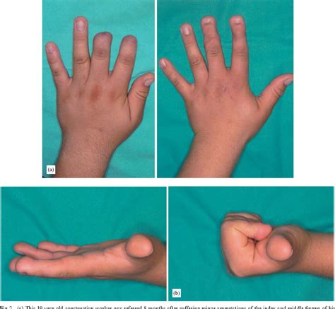 [PDF] The indications for toe transfer after "minor" finger injuries. | Semantic Scholar