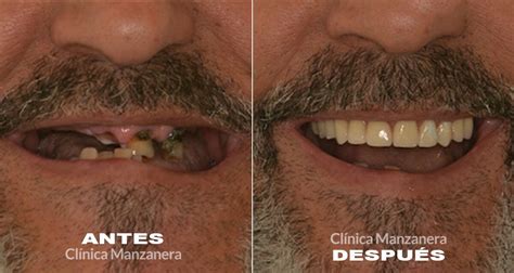 Implantes inmediatos: Tu sonrisa en 24 horas - Caso Real - Clinica ...