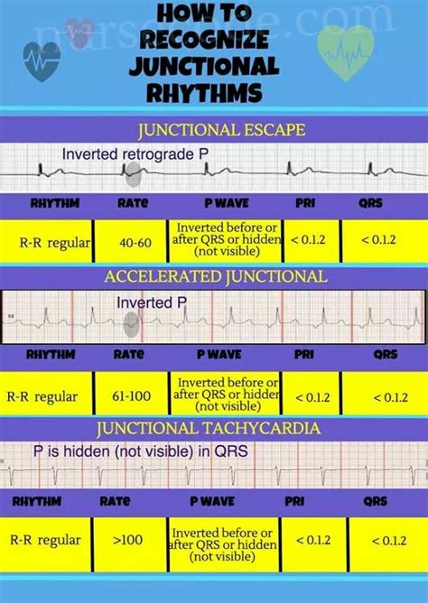 How to recognize junctional rhythms. MedicTests.com Nursing School Studying, Nursing School ...