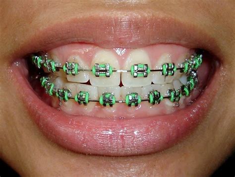 Is Green A Good Color For Braces – Warehouse of Ideas