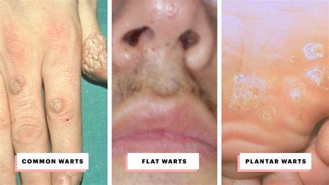 Types of Warts and How to Treat Them - A Visual Guide | Allure