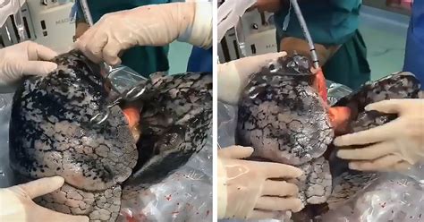 Shocking Images Show the Black Lungs of 52-Year-Old Smoker Who Smoked a Pack Daily for 30 Years