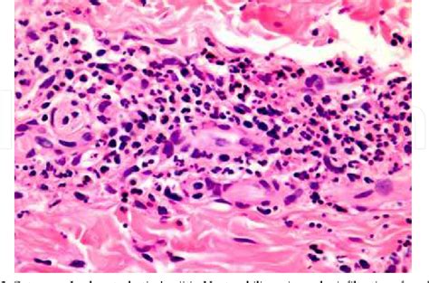 Leukocytoclastic Vasculitis Histology