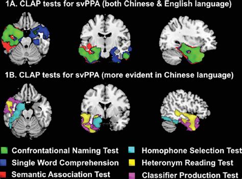 Semantic variant Primary Progressive Aphasia: Additional semantic features in Chinese language ...