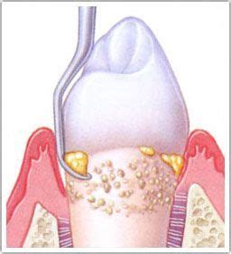 Subgingival scaling | Periodontitis, Dental hygiene, Dentist