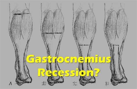 Should You Get Gastrocnemius Recession Surgery? - Regenexx