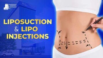 LIPOSUCTION AND LIPO INJECTIONS: 4 BASIC DIFFERENCES AND WHAT BENEFITS ...