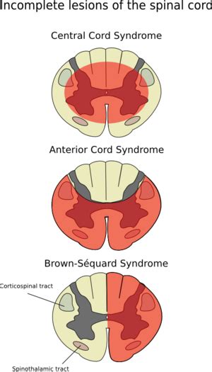 Anterior spinal artery syndrome - Wikipedia