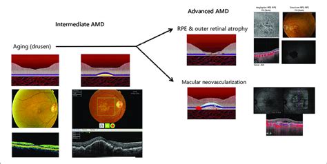 Different stages of AMD starting at normal aging, going through ...