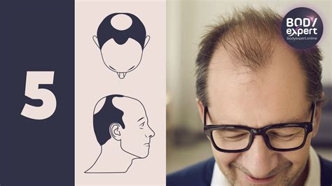 Norwood-Hamilton scale: the 7 stages of male pattern baldness