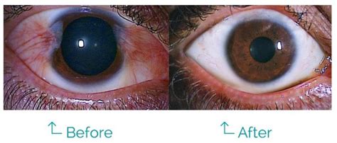 Differences: Pinguecula vs Pterygium - OasisEye Specialists