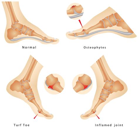 What is Turf Toe? - Sterling Foot Doctor Shuman Podiatry & Sports Medicine