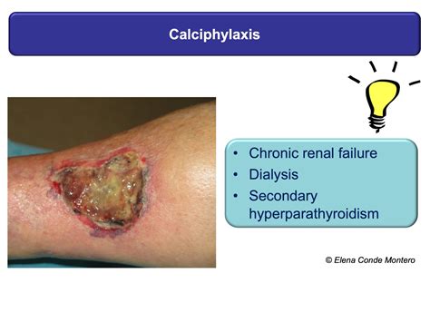 Necrosis and purple edges in leg ulcers: keys to guide your diagnosis