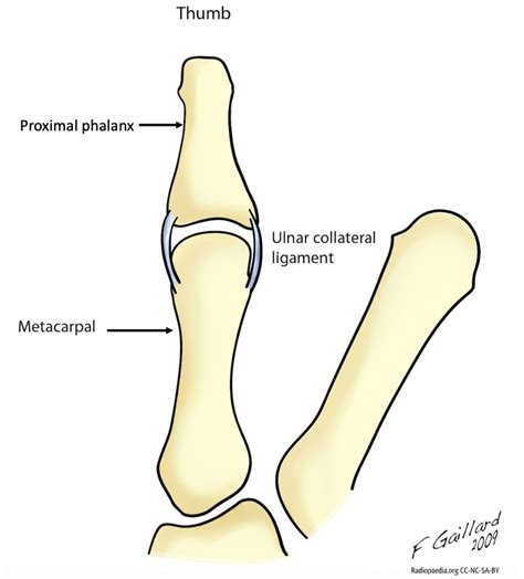 Thumb Ulnar Collateral Ligament Sprain