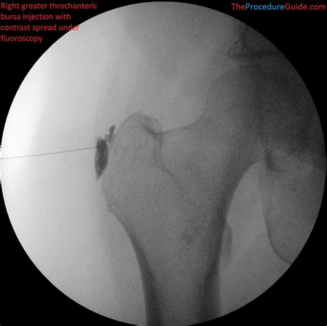 Trochanteric Bursitis X Ray