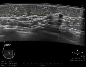 Dense breast tissue and automated breast ultrasound