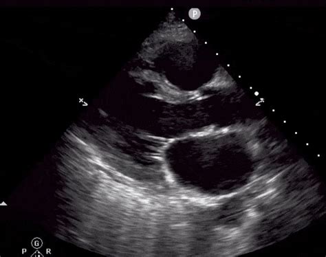 Measure Left Ventricular Ejection Fraction With Echocardiography in 2021 | Ultrasound, Cardiac ...