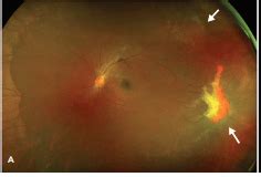 Sickle Cell Retinopathy Causes & Symptoms | Windy City Retina