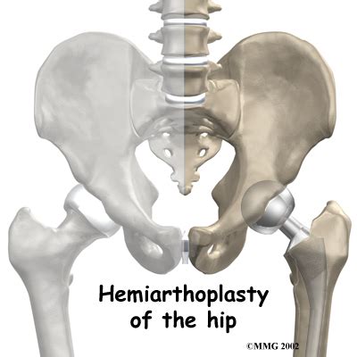 Physical Therapy in Lowell for Hip Surgery - Hemiarthroplasty