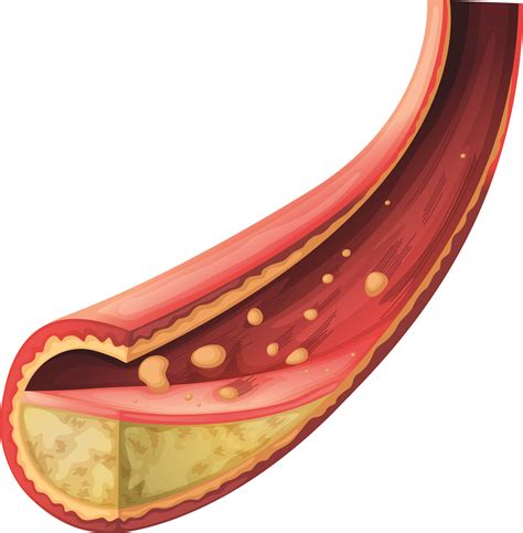 LDL (Low Density Lipoprotein - lipoproteínas de baixa densidade) | Atlas da Saúde