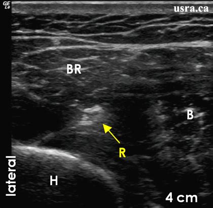 Radial Nerve: Ultrasound Radial Nerve Block At Elbow