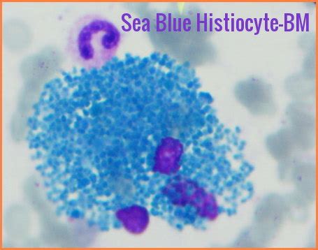 Sea Blue Histiocytes | Ask Hematologist | Understand Hematology