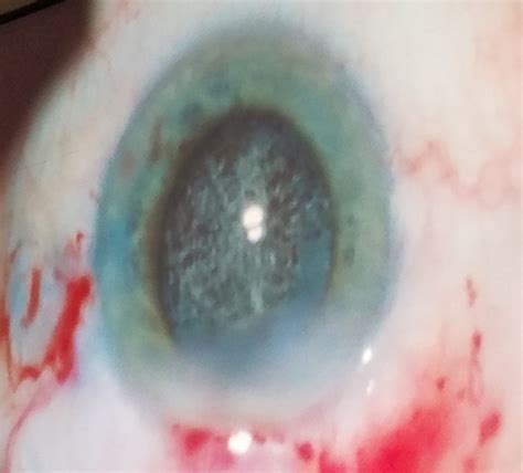 What Is This Benign Ocular Diagnosis? | Consultant360