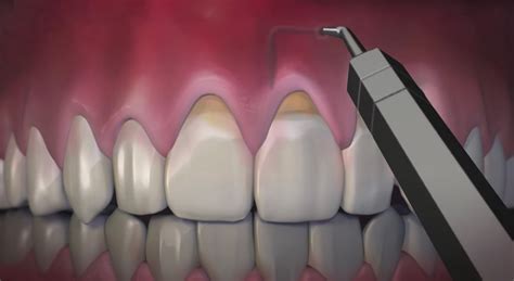 Pinhole Surgical Technique PST™ | Arkansas Periodontal and Implant Associates