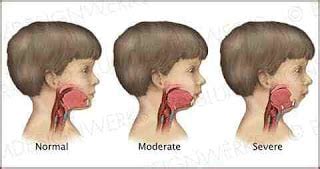 Mandibular Hypoplasia: Causes, Symptoms, Treatment, And Surgery