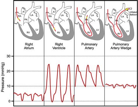 Pulmonary capillary wedge pressure & pulmonary artery wedge pressure