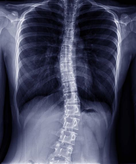 Anesthesia Considerations for Patients with Scoliosis - Connecticut ...