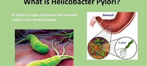 5 Ways to Treat H Pylori the Natural Way - WorthvieW