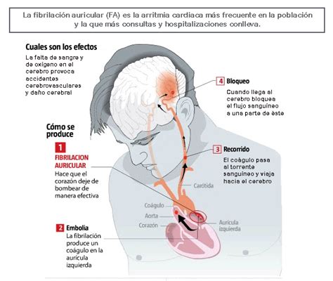 Cómo Afecta Al #Corazón La #Fibrilación #Auricular | TUSALUDESVIDA | Fibrilación auricular ...