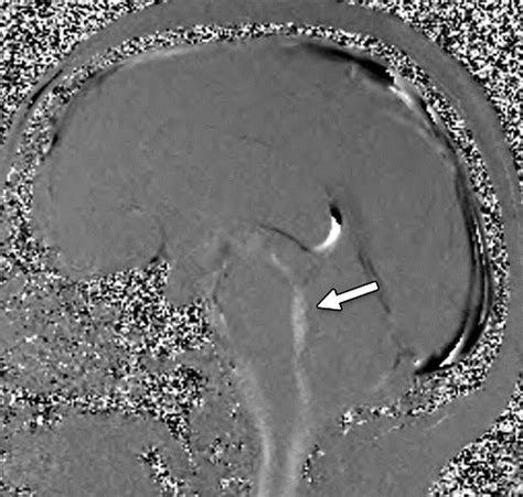 Phase-Contrast MRI: Physics, Techniques, and Clinical Applications | RadioGraphics