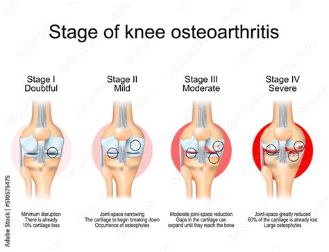 Stages of knee osteoarthritis Stock Vector | Adobe Stock