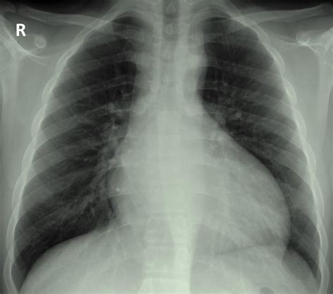 Aortic regurgitation chest x-ray - wikidoc