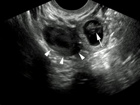 Condition Specific Radiology: Ectopic Pregnancy - Stepwards