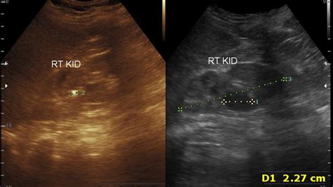 Ultrasound cases 366 of 2000 || renal calculi ||kidney cortical cyst ...