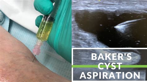 Simple Baker's Cyst Aspiration - YouTube