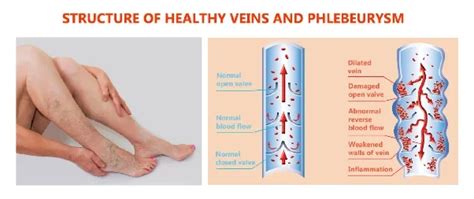 Venous Reflux Treatment Singapore | Dr. Darryl Lim