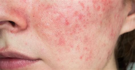 What is Post Inflammatory Erythema And How Do You Treat It?