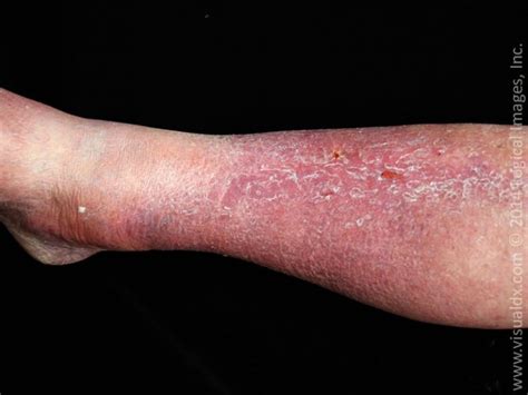 Cellulitis and its Mimickers | VisualDx