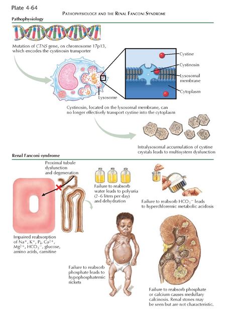 CYSTINOSIS - pediagenosis