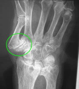 Thumb Arthritis - Causes, Symptoms, Exercises, Splint & Treatment